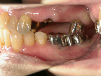 インプラント治療前