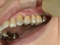 インプラント治療後