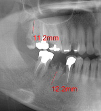 レントゲン撮影