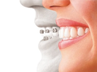 青島歯科クリニック／マウスピース型矯正