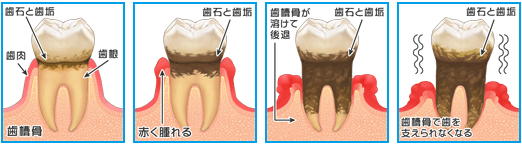 歯周病治療