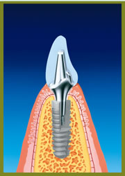 審美歯科の治療例